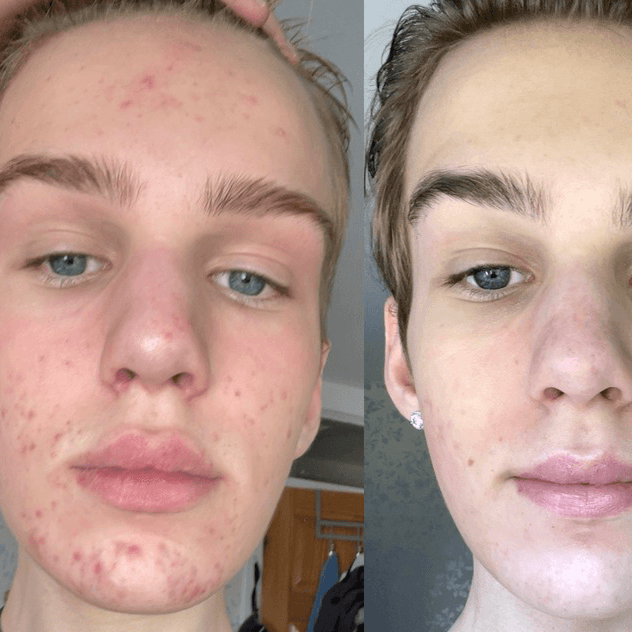 Teen Skin Reset Series at Collective Beauty Lounge in Cottonwood, AZ